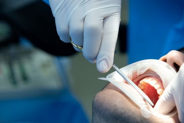 Tooth Extractions