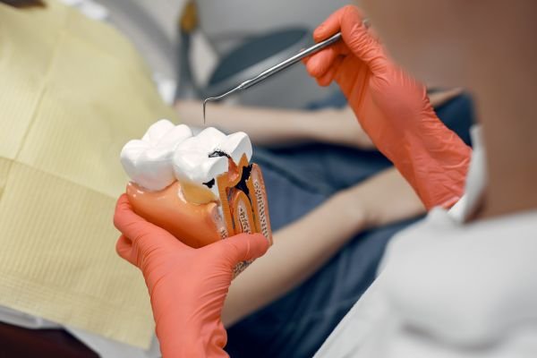 Composite Filling