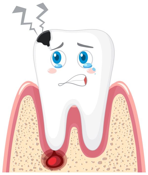 Impaction
