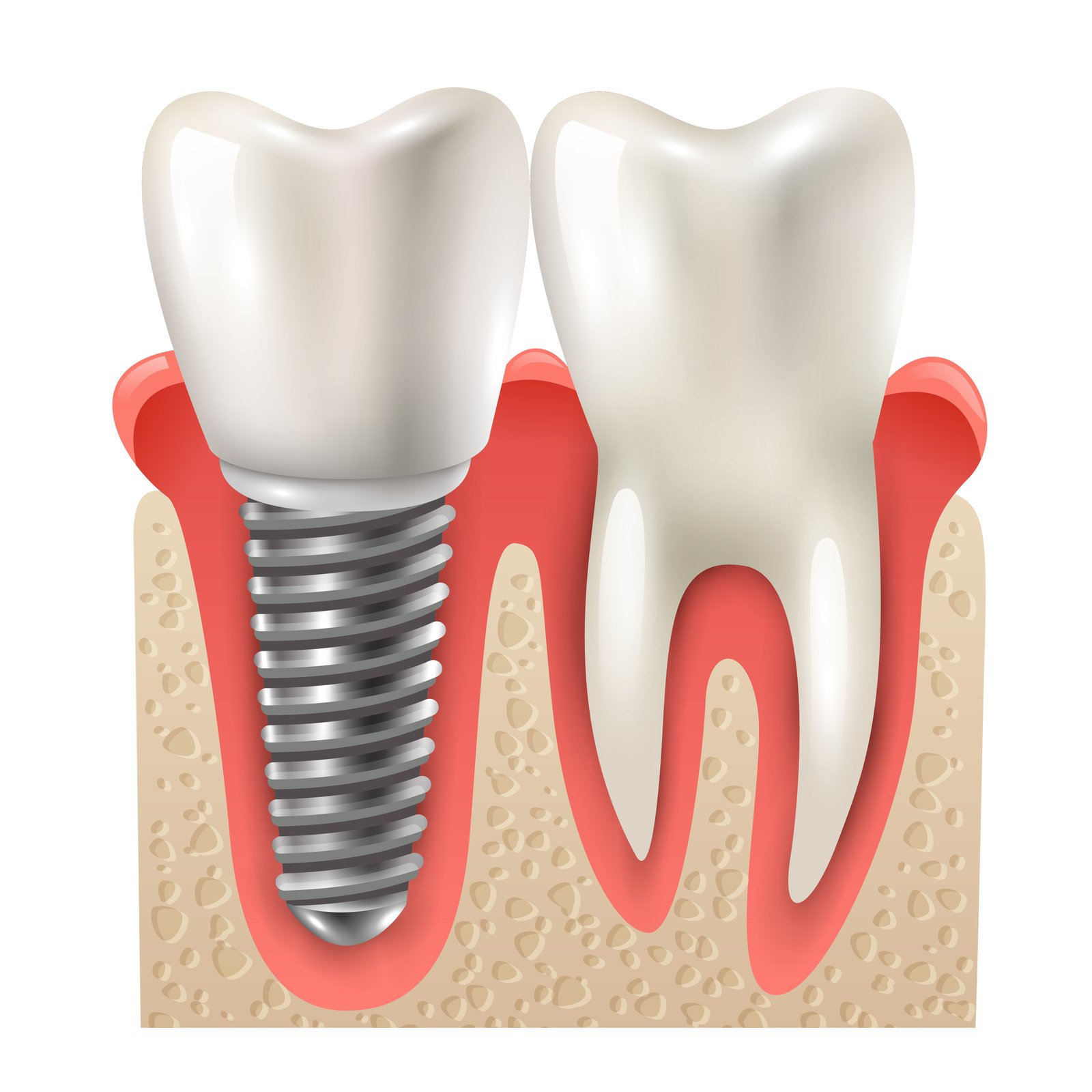 Smile Design